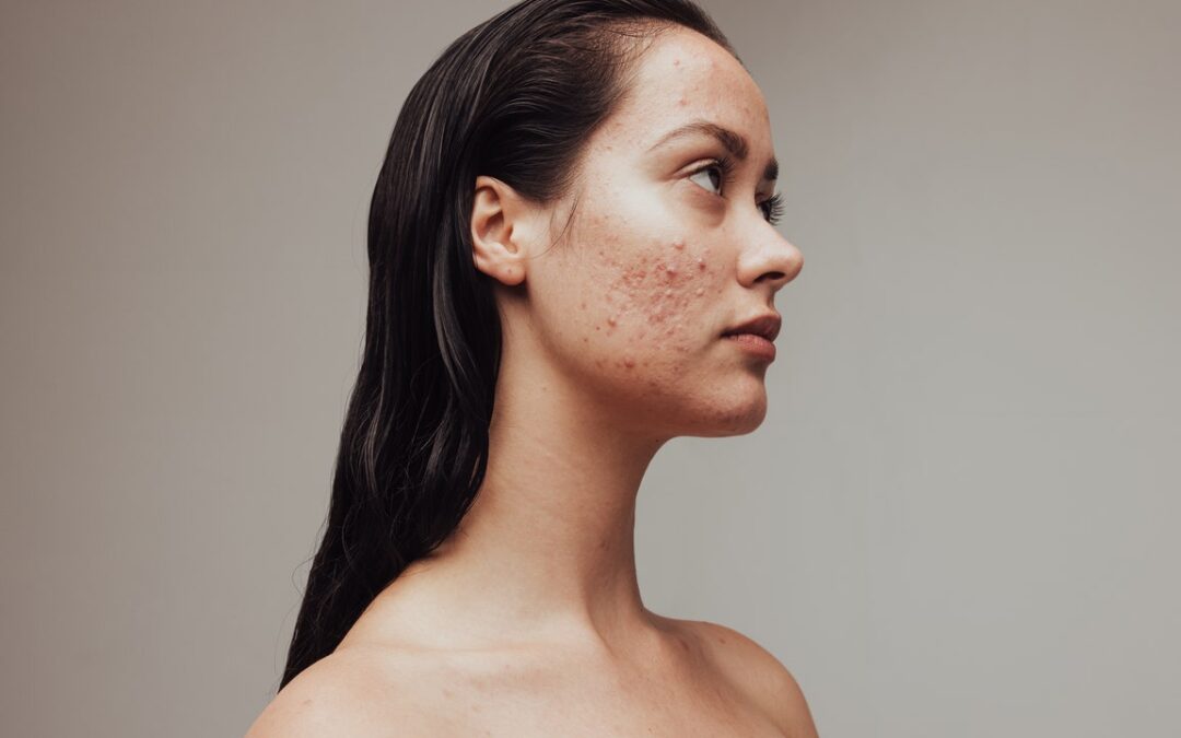 How To Treat Every Type of Adult Acne at Home: Cystic Acne, Blackheads, Acne Scars, and More