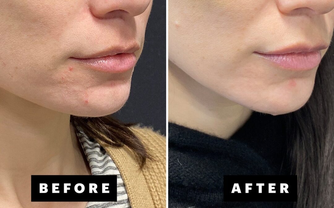 I Tried the New AviClear Laser for My Hormonal and Cystic Acne