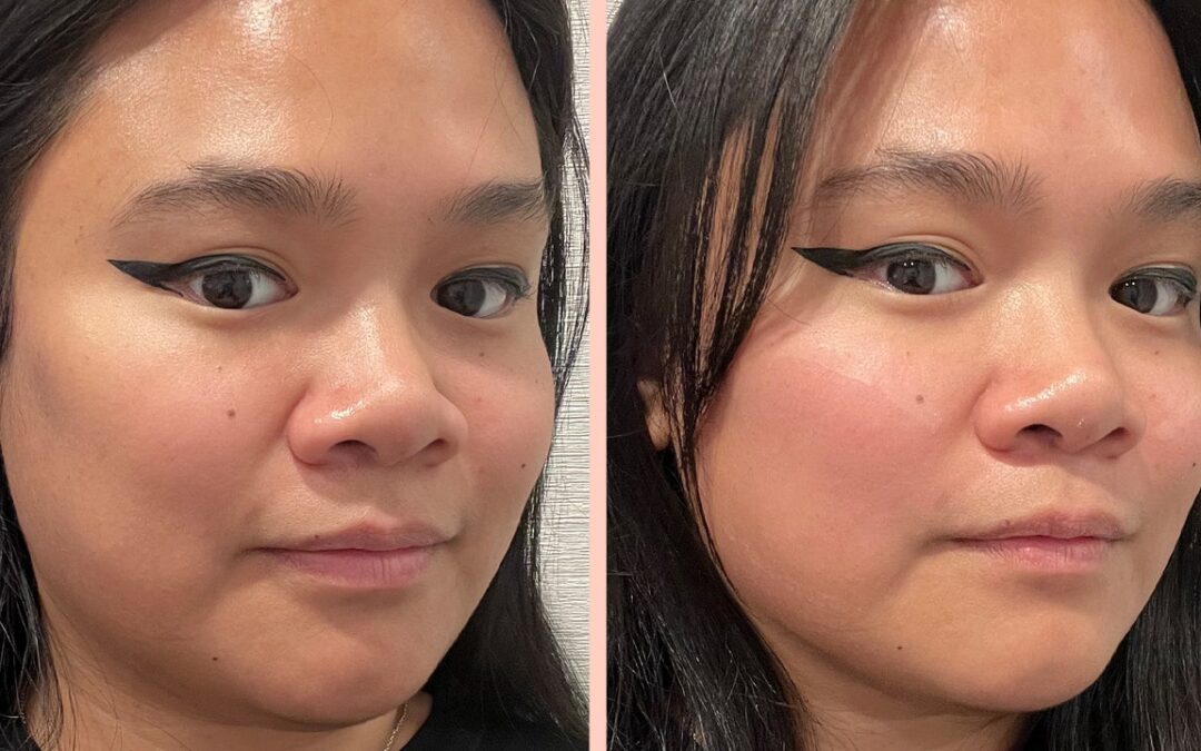 Emface Review With Photos: Is It a Needle-Free Alternative to Botox and Filler?