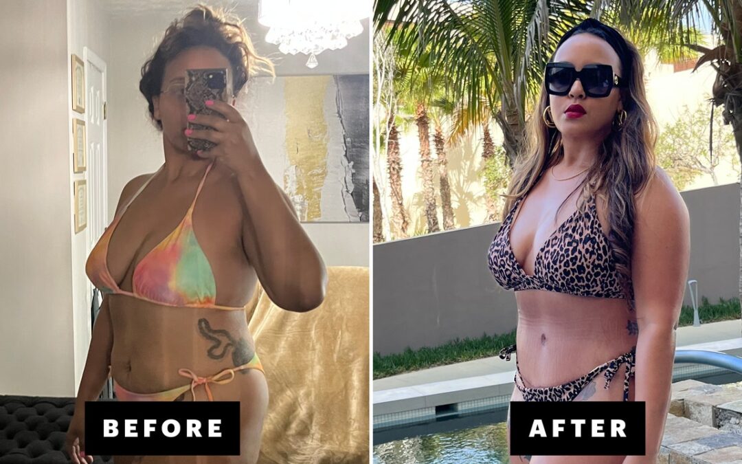 My Experience With Liposuction and a Tummy Tuck as a Patient With Brown Skin — Review With Before & After Photos