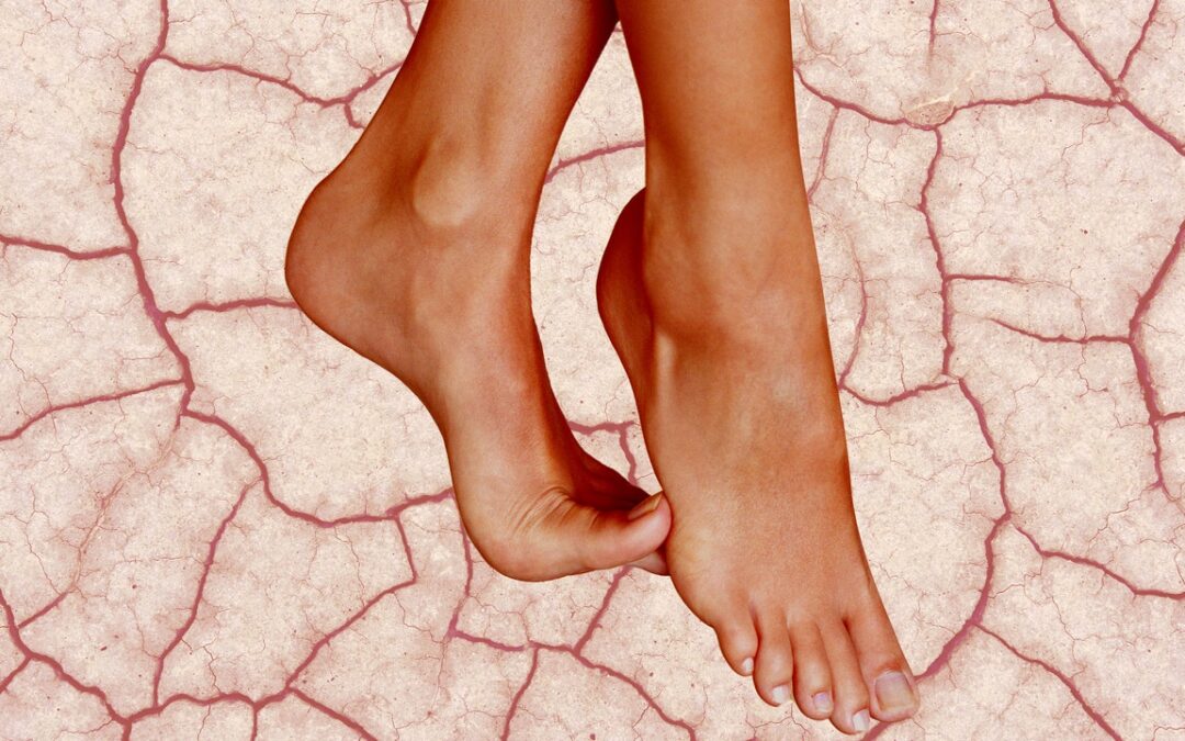 How to Care for Dry, Cracked Heels in 2023 — Expert Advice