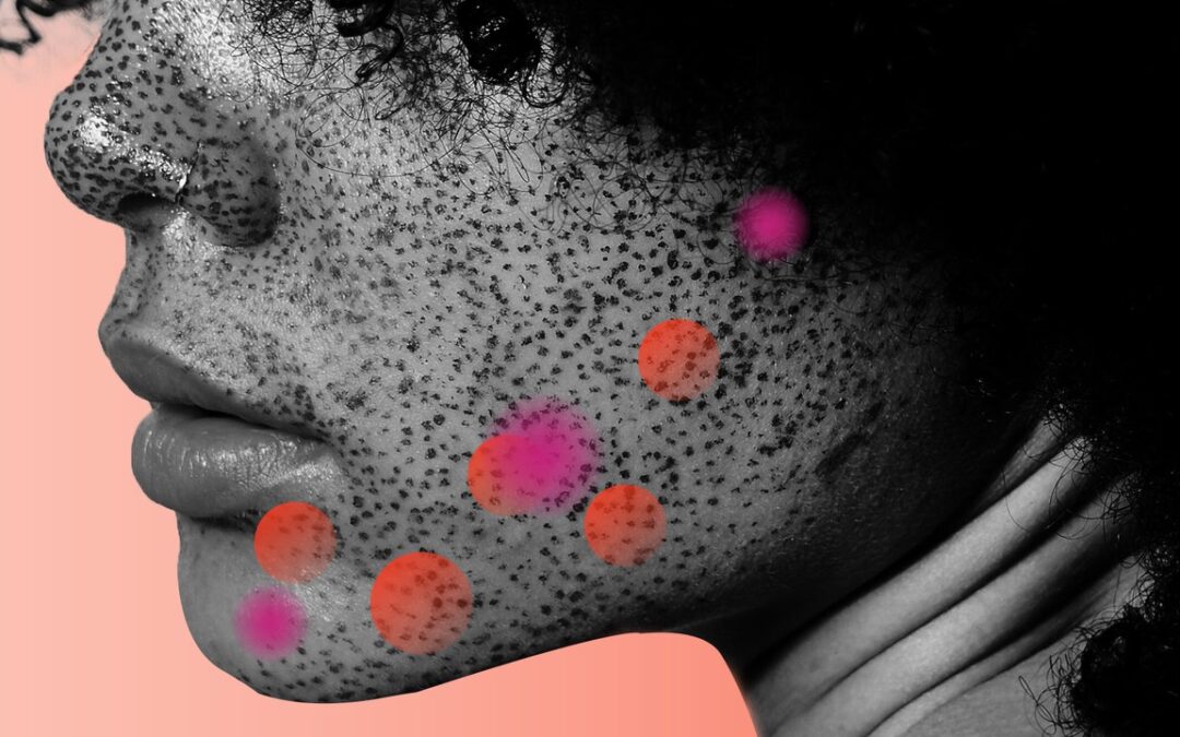 Cystic Acne: How to Treat and Prevent Breakouts — Expert Tips
